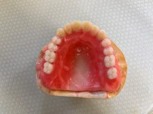 湘南歯科医院で行っているドイツ式の義歯の作製方法（2）