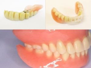 湘南歯科医院がお薦めする「テレスコープシステム」義歯治療