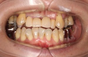 矯正治療と補綴治療の併用例−症例1