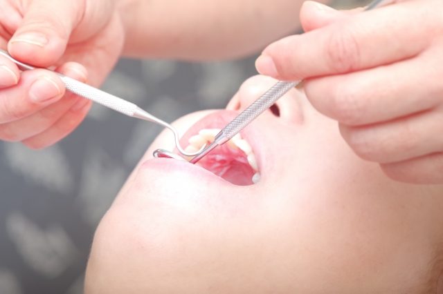 歯を削ると虫歯になりやすいってホント?